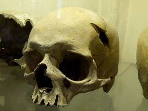 Schädelverletzung durch Schwerthieb oder Axthieb